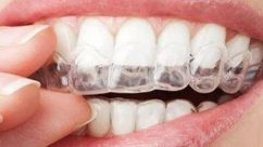 Time In Braces: Factors That Affect Your Treatment Rate